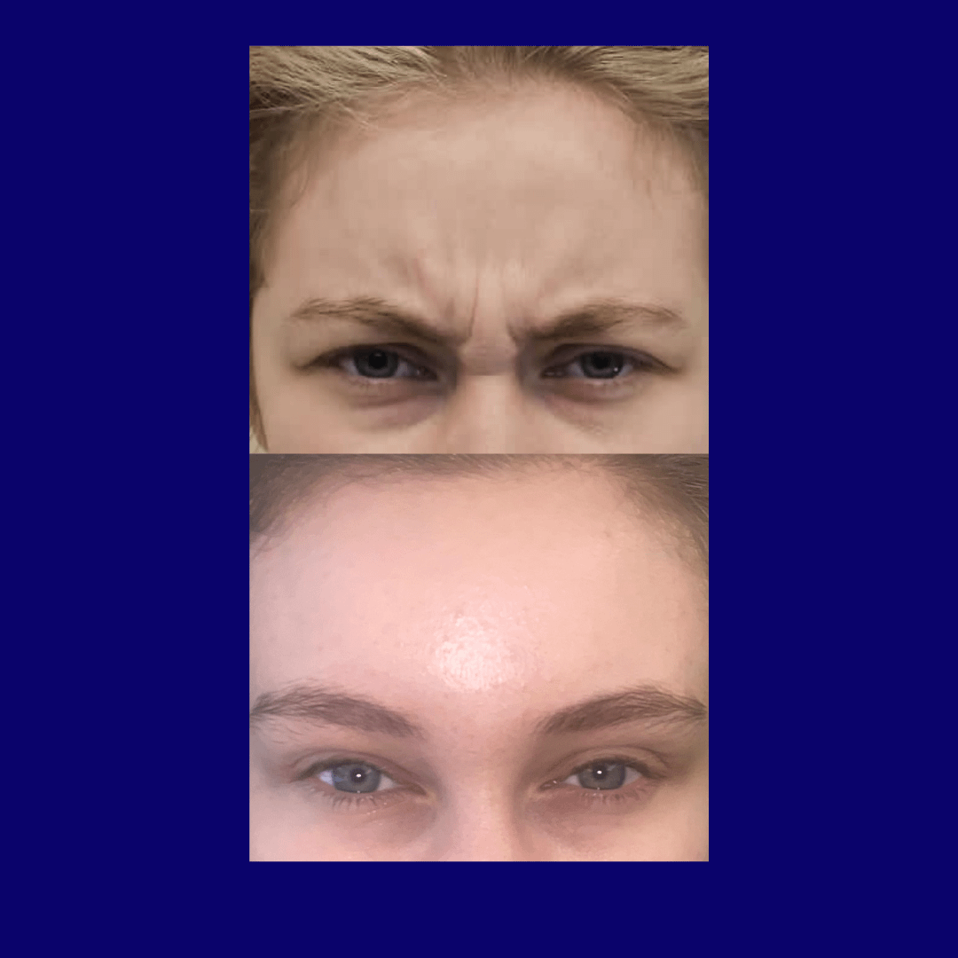 Before & After Anti-Wrinkle Injections 3 areas