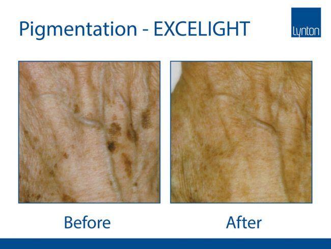 Pigmentation Removal/Reduction