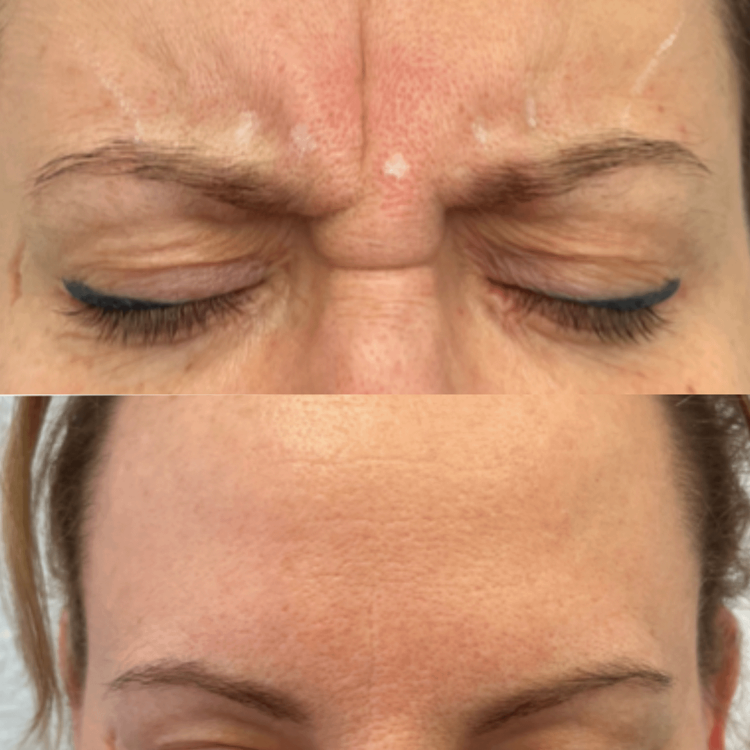 anti wrinkle injections