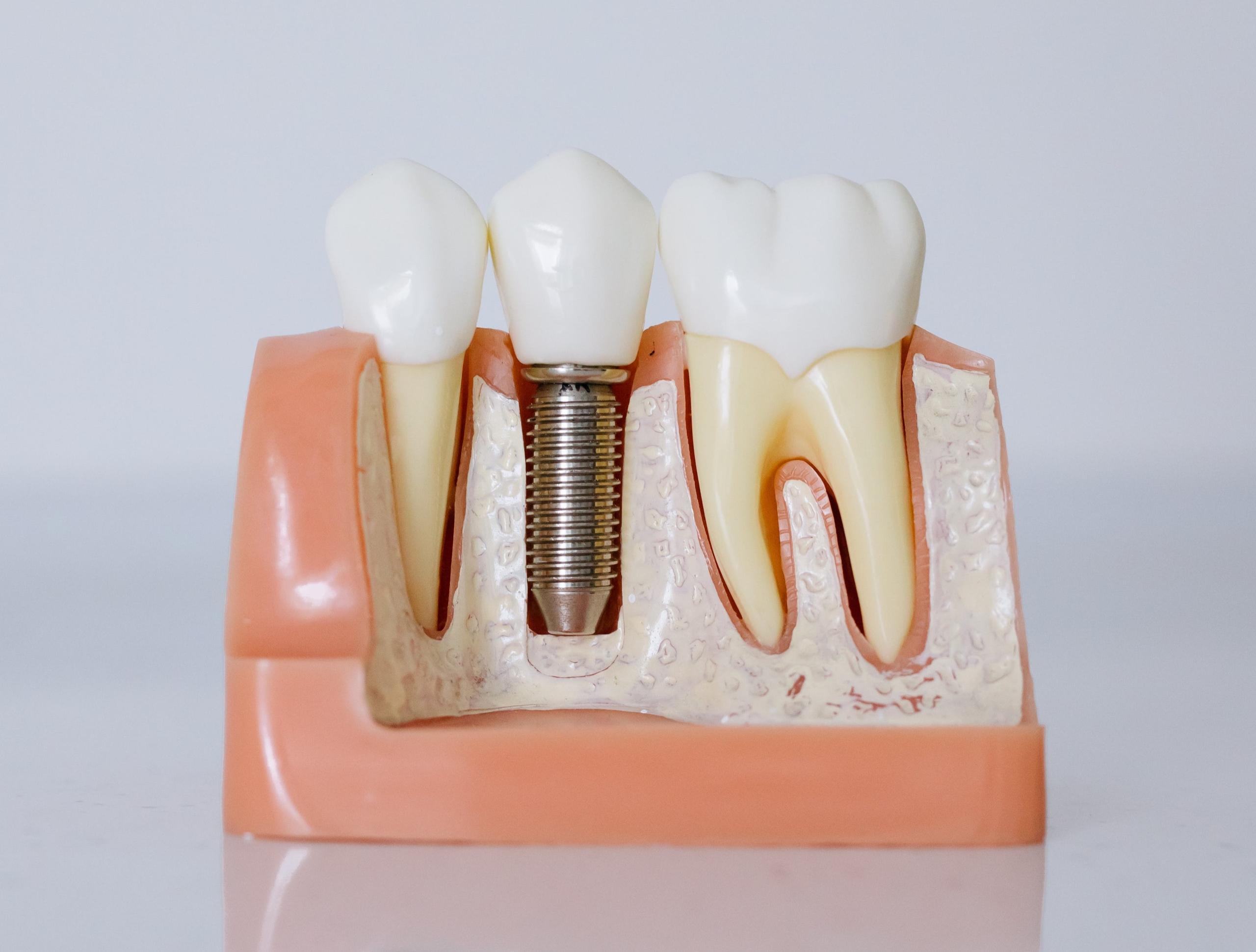 Dental implants