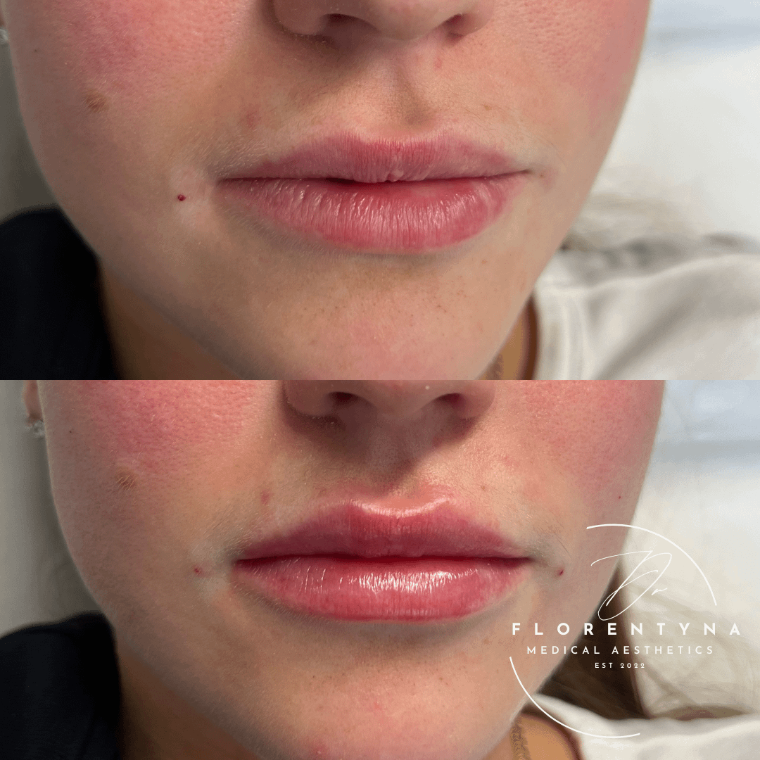 lip filler lip enhancement